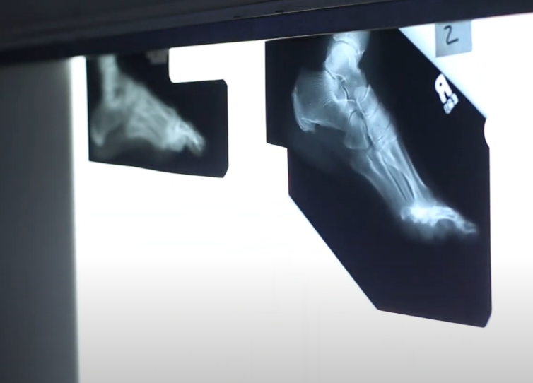 xray of foot